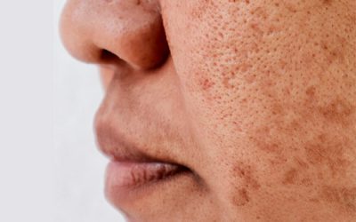 What causes hyperpigmentation?